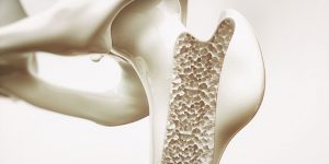 Genetic Prerequisites For Osteoporosis
